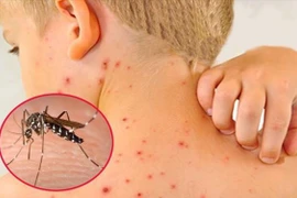 Dấu hiệu sốt xuất huyết cần đến viện ngay