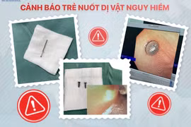 Hai chiếc đinh vít sắc nhọn, nguy hiểm trong bụng trẻ