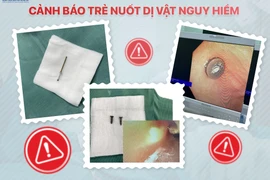 Hai chiếc đinh vít sắc nhọn, nguy hiểm trong bụng trẻ