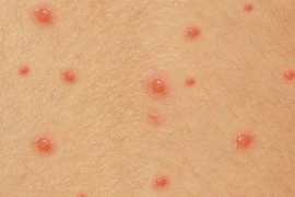 Chuyên gia mách cách bôi thuốc và kiêng ăn để thủy đậu nhanh khỏi