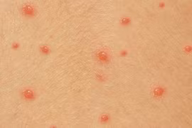 Chuyên gia mách cách bôi thuốc và kiêng ăn để thủy đậu nhanh khỏi