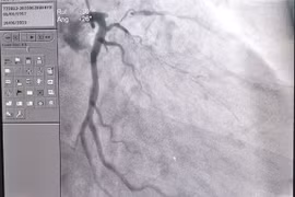 Lý do người đàn ông hẹp khít động mạch vành khi đi khám sức khỏe