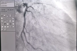 Lý do người đàn ông hẹp khít động mạch vành khi đi khám sức khỏe