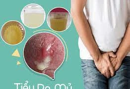 Đái buốt ra mủ là bệnh gì?