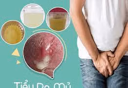 Đái buốt ra mủ là bệnh gì?