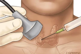 Ngưng thuốc chống đông máu khi chọc tuyến giáp có gây đột quỵ?