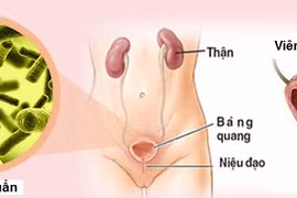 Bác sĩ chỉ rõ biểu hiện bạn bị viêm bàng quang