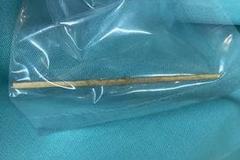 Tăm tre 10 cm đâm thủng đại tràng