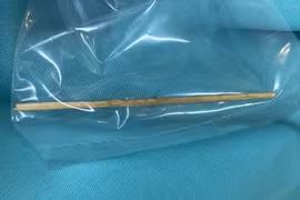 Tăm tre 10 cm đâm thủng đại tràng