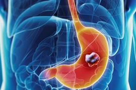 Chuyên gia chỉ rõ đối tượng và dấu hiệu "báo động đỏ" ung thư dạ dày