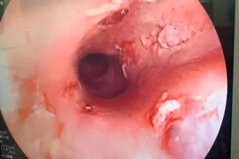 Gắp mảnh xương cá lớn cắm sâu trong thực quản người bệnh
