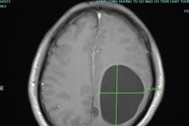 Thích tiết canh, rau sống quý ông liệt nửa người vì đa kén sán não