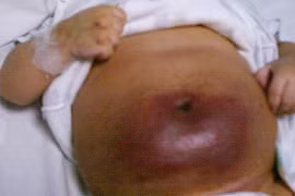 Cứu trẻ sơ sinh khít hẹp đường thở, u máu khổng lồ do hội chứng Kasabach-Merit