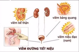 Bác sĩ mách chị em cách tránh viêm đường tiết niệu trời nồm ẩm