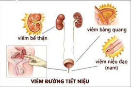 Nồm ẩm làm tăng nguy cơ viêm đường tiết niệu ở phụ nữ