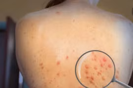 Phát hiện ca đậu mùa khỉ thứ 6, tiết lộ kiểu gen nội địa đầu tiên