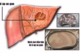 Áp-xe gan nguy kịch vì tưởng sốt thông thường