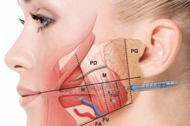Tiêm botox chống nhăn, gọn mặt