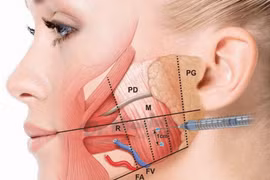 Tiêm botox chống nhăn, gọn mặt