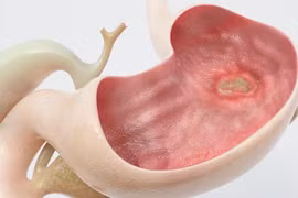 Ợ nóng, ợ chua có thể là bệnh lý của dạ dày