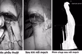 Kính vỡ cắt đứt động mạch quay người đàn ông 51 tuổi