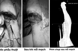 Kính vỡ cắt đứt động mạch quay người đàn ông 51 tuổi