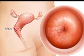 Cách phát hiện sớm bệnh ung thư tử cung