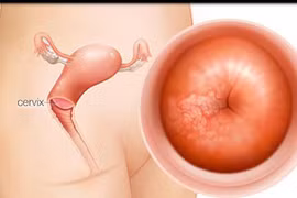 Cách phát hiện sớm bệnh ung thư tử cung