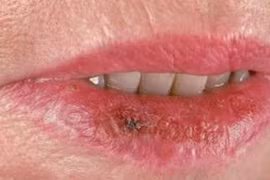 Nguyên nhân hàng đầu gây ung thư môi