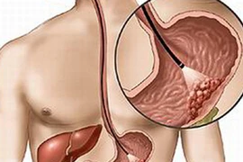 Sự nguy hiểm của bệnh ung thư dạ dày