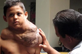 Gỡ thành công khối u khổng lồ trên vai bé 11 tuổi