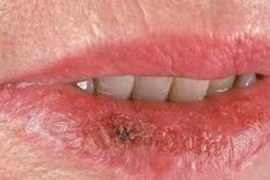 Những điều nên biết về ung thư môi