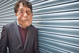 Trải lòng đau đớn của diễn viên có bộ mặt người voi