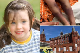 Bé gái suýt mất 2 chân do biến chứng thủy đậu