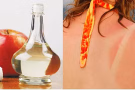 Da cháy nắng đen sì, làm sao để nhanh trắng lại?