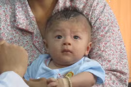 Bé trai bị đâm xuyên sọ mắc viêm màng não mủ