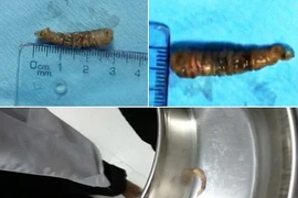 Kinh hoàng con sâu dài 3cm ký sinh trong mắt bệnh nhân