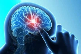 Bị xuất huyết não vì thường xuyên ăn loại gia vị này