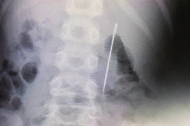 Giấu mẹ một việc, bé 8 tuổi suýt thủng ruột, phải phẫu thuật gấp