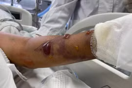 Dùng tay rửa cá, lão ngư nhiễm vi khuẩn 'ăn thịt người'