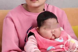 Dùng kem bôi ngoài da, bé 5 tháng phù mặt, đầu to bất thường