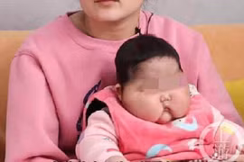 Dùng kem bôi ngoài da, bé 5 tháng phù mặt, đầu to bất thường