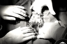 Phẫu thuật thành công u quái to gấp 5 lần quả thận bình thường