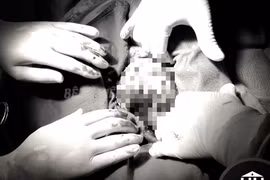 Phẫu thuật thành công u quái to gấp 5 lần quả thận bình thường