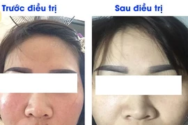 Trị nám ở spa, cô gái đau đớn mang ổ viêm trên mặt