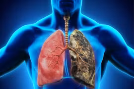 Những dấu hiệu trên chân có thể “dự đoán” ung thư phổi