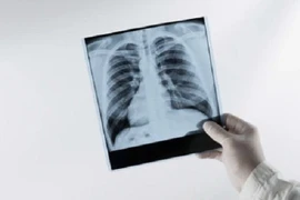 Chụp X-quang phát hiện nhiều người trẻ phổi trắng xóa, nguyên nhân vì sao?