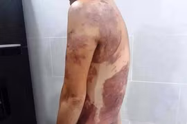 Nhắc hàng xóm đỗ xe ô tô, người phụ nữ bị hắt cả chảo dầu sôi vào người