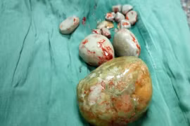 Bà cụ mang viên sỏi to bằng cái chén trong bàng quang