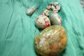 Bà cụ mang viên sỏi to bằng cái chén trong bàng quang